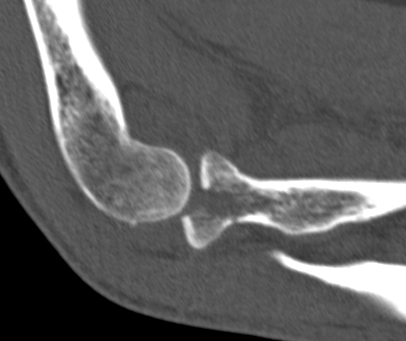 Radial Head Fracture Type 2 CT